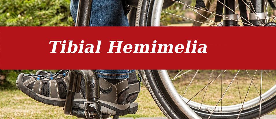 Tibial Hemimelia Treatment, Symptoms And Causes