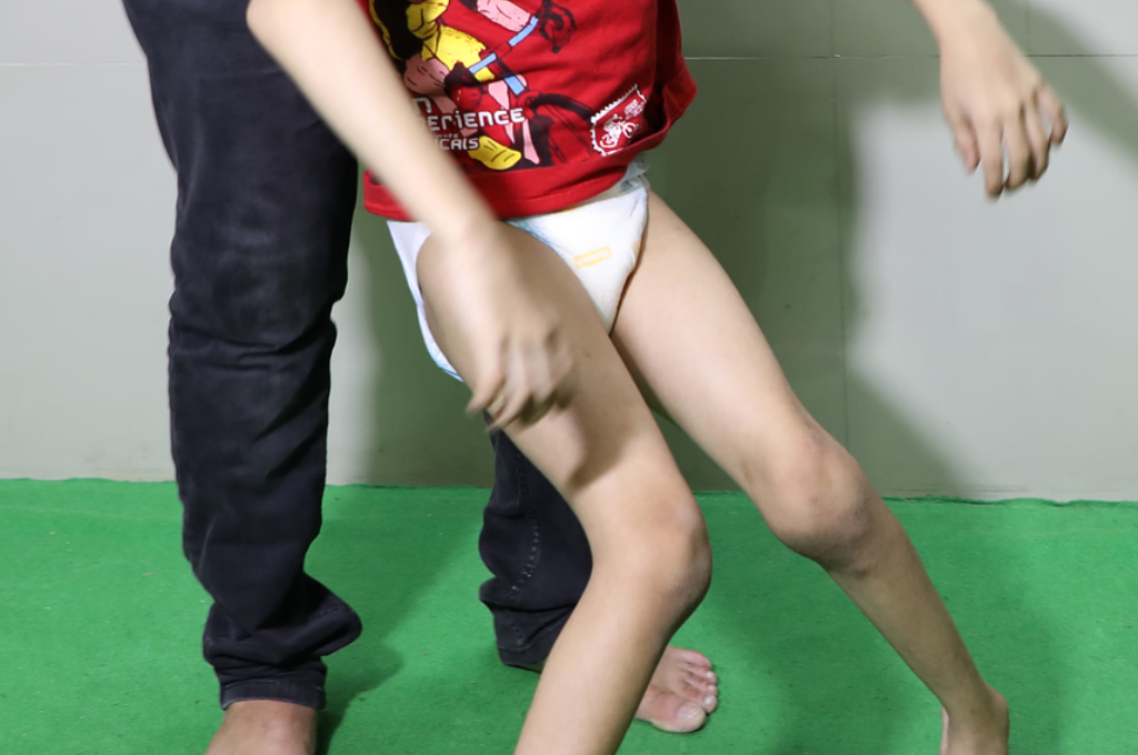 Dystonic Cerebral Palsy