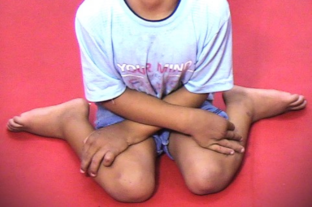 Atonic Cerebral Palsy